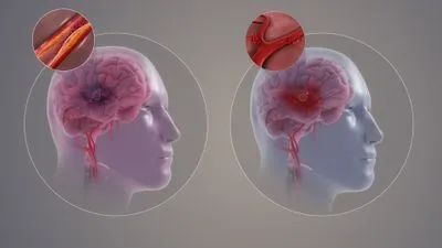 أسباب جلطات الدماغ