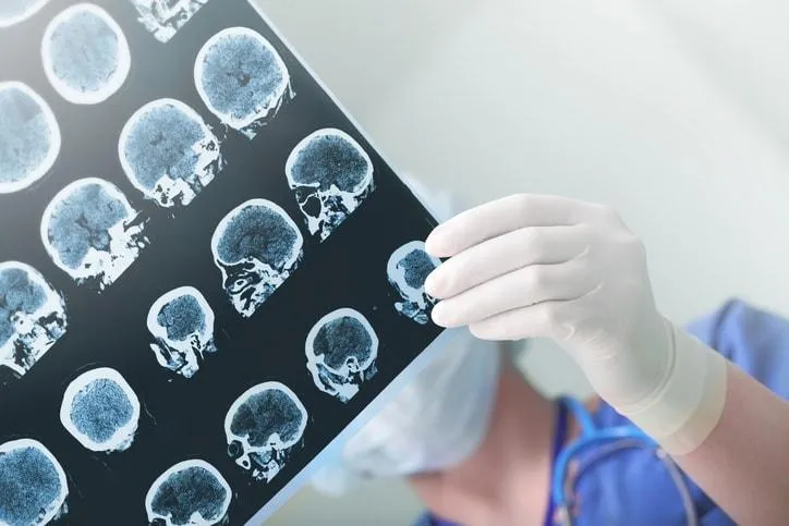 علاج جلطات الدماغ