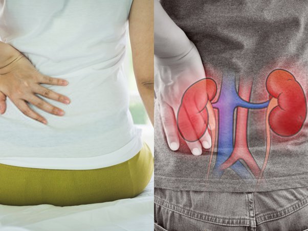 تشخيص أمراض الكلى المزمنة